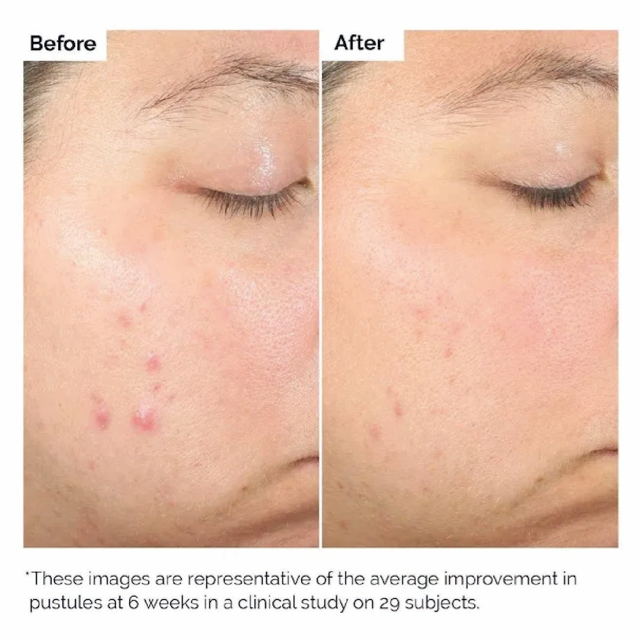 the ordinary salicylic acid